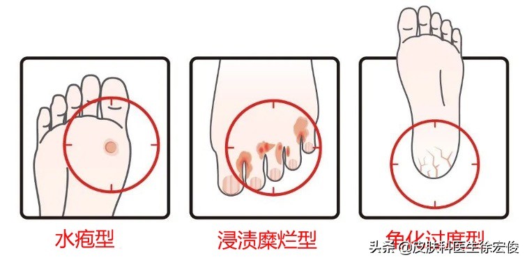 怎么根治夏季的脚气,去脚气小妙招水泡型脚气