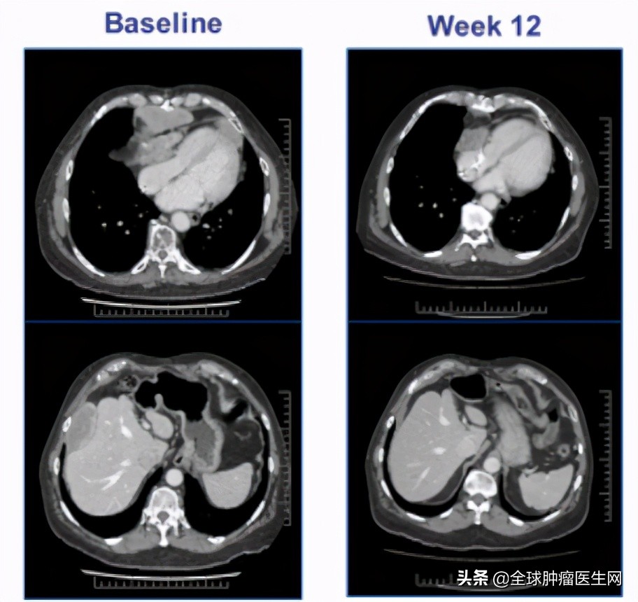 赶超CAR-T!新型T细胞免疫疗法TCR-T大战实体瘤