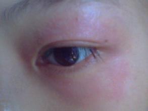 下眼睑黑眼圈特别严重是怎么回事,黑眼圈严重眼袋浮肿是什么原因