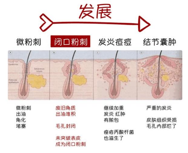 去闭口快速有效的方法,去闭口最有效的方法推荐