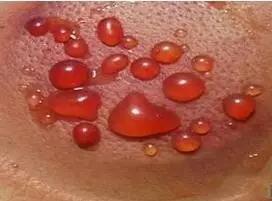 拔罐时出现罐印红是怎么回事,怎样快速消除拔罐留下的罐印