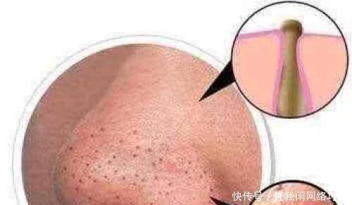 满婷除螨皂去黑头,美容除螨去黑头