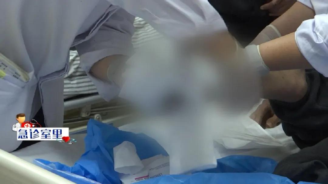 久拖成重疾！男子右脚冻伤后严重坏死