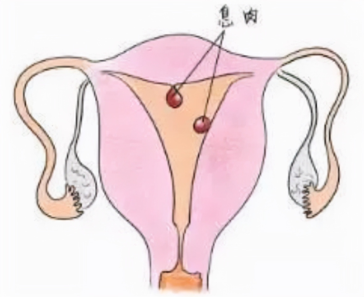 子宫息肉不孕中医疗法,不孕喝中药喝出子宫息肉