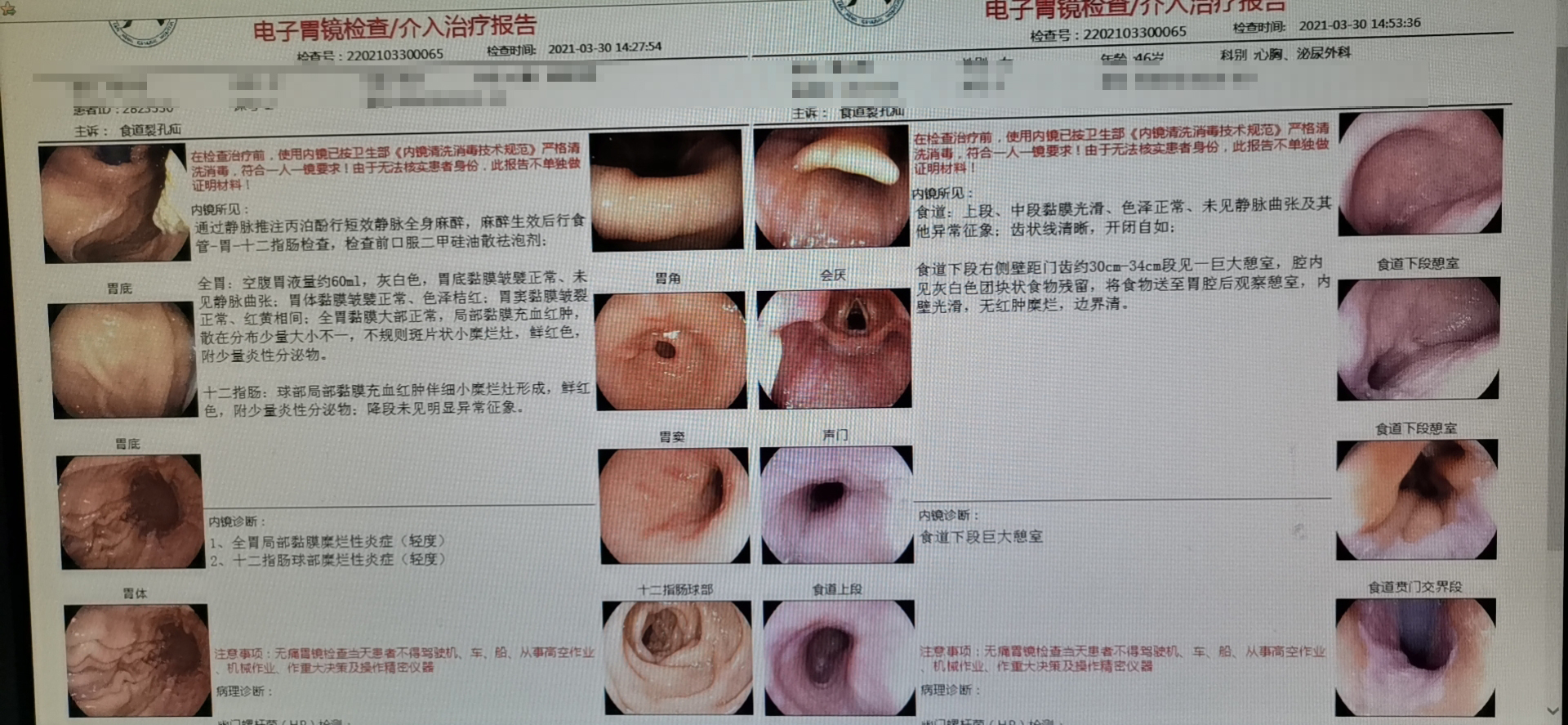 盘江总医院成功开展首例食管憩室切除+食管重建术