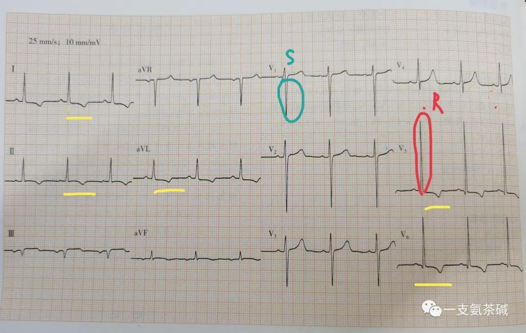 心电图90-100,心电图九九八十一难口诀