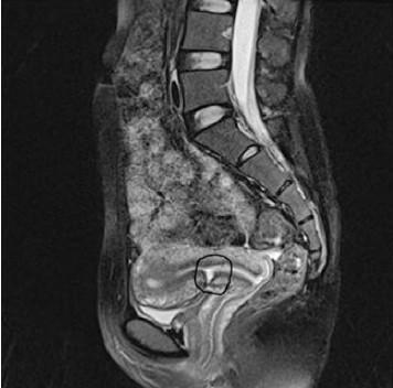 剖宫产瘢痕憩室英文,剖宫产术后瘢痕憩室诊治专家共识