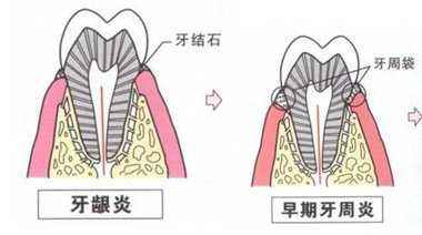 夜晚牙痛最快止痛的方法小妙招,经常牙痛的人怎么调理