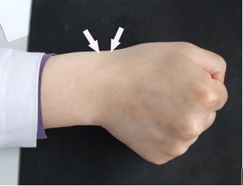 手腕腱鞘囊肿没肿但是痛怎么处理,手腕突然鼓起硬包摸起来不痛