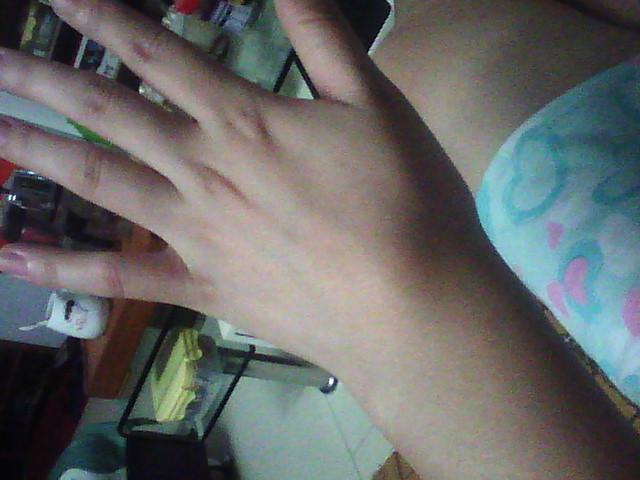 手腕腱鞘囊肿没肿但是痛怎么处理,手腕突然鼓起硬包摸起来不痛