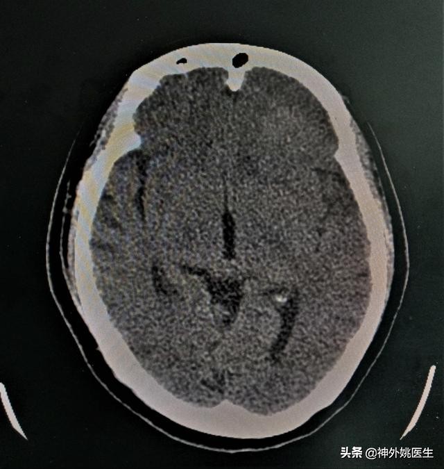 脑膜瘤是什么原因引起的啊,脑膜瘤手术治疗全部大概多少钱