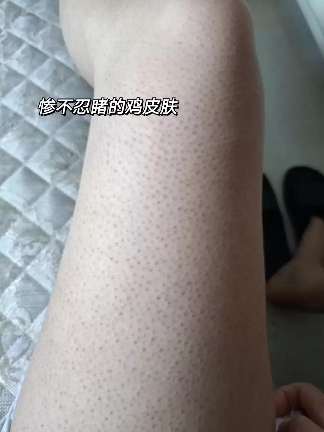新手去鸡皮方法！皮肤一天比一天滑溜