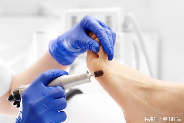 脚底死皮一撕一大块,脚底死皮撕到肉了