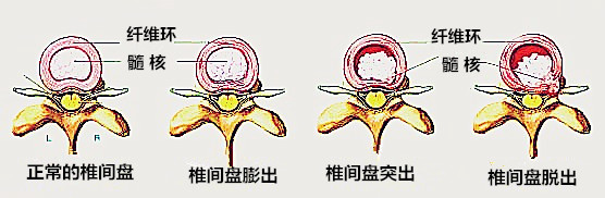 女性为什么会得腰间盘突出,女性腰椎间盘突出最佳锻炼方法