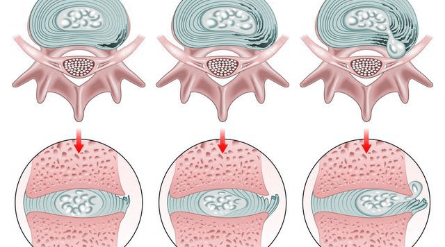 腰间盘突出压迫神经痛如何缓解,腰间盘突出压迫神经怎么锻炼缓解