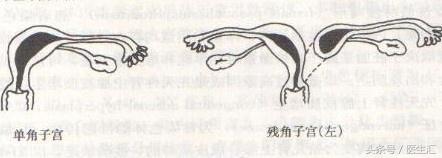 单角子宫妊娠是什么意思,单角子宫会有什么症状