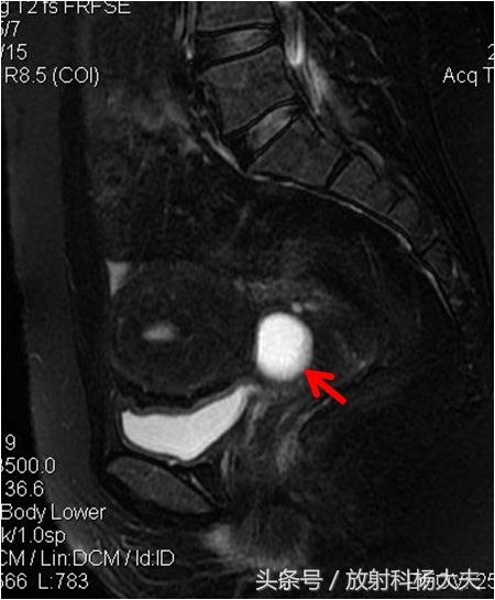 做子宫核磁经常遇到的一种病,大部分女性不知道其根本不用治疗