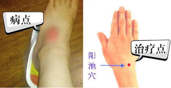 中医上病下治是什么意思,上病下治左病右治穴位图片