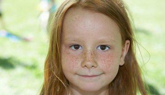 斑点的原因及治疗方法图解,什么原因会导致斑点越来越多