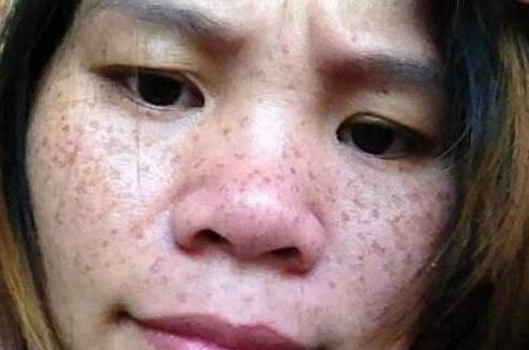 斑点的原因及治疗方法图解,什么原因会导致斑点越来越多