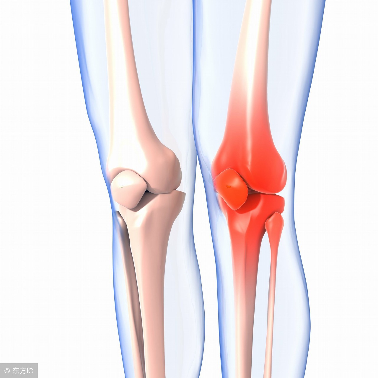 哪些骨关节疾病需要康复治疗,治疗骨关节疾病的方法