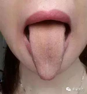 舌头是人体健康的晴雨表,舌头是健康的信号灯