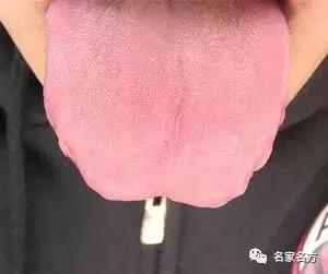 舌头是人体健康的晴雨表,舌头是健康的信号灯