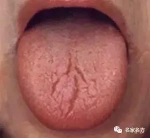 舌头是人体健康的晴雨表,舌头是健康的信号灯