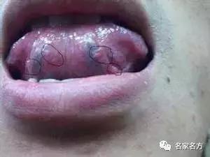 舌头是人体健康的晴雨表,舌头是健康的信号灯