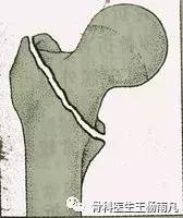 鬼门关前一道坎（上篇）：家里老人滑到了，胯部骨折了严重吗？