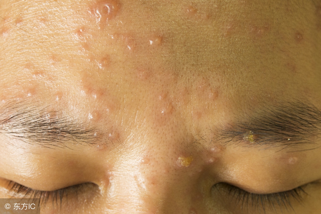 大人水痘会传染吗,大人水痘会传染给宝宝吗