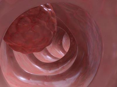 大便粘马桶是怎么回事如何治,大便粘马桶怎么回事怎样解决