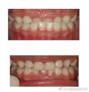 30多岁还可以正畸吗,30多岁还适合做正畸吗