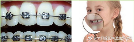 30多岁还可以正畸吗,30多岁还适合做正畸吗