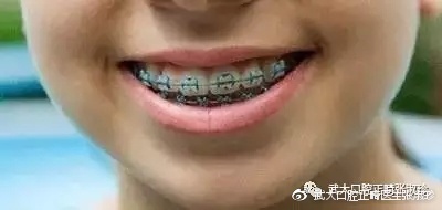 30多岁还可以正畸吗,30多岁还适合做正畸吗