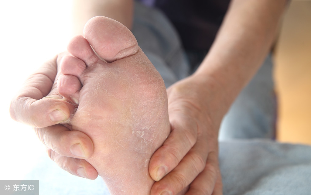 抗真菌药物选择达克宁还是派瑞松,金达克宁针对什么真菌