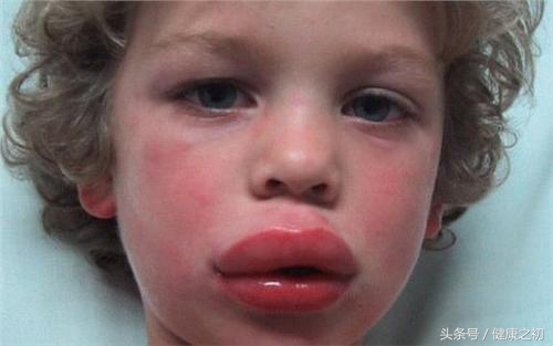 花生过敏怎么快速缓解,花生过敏是什么原因