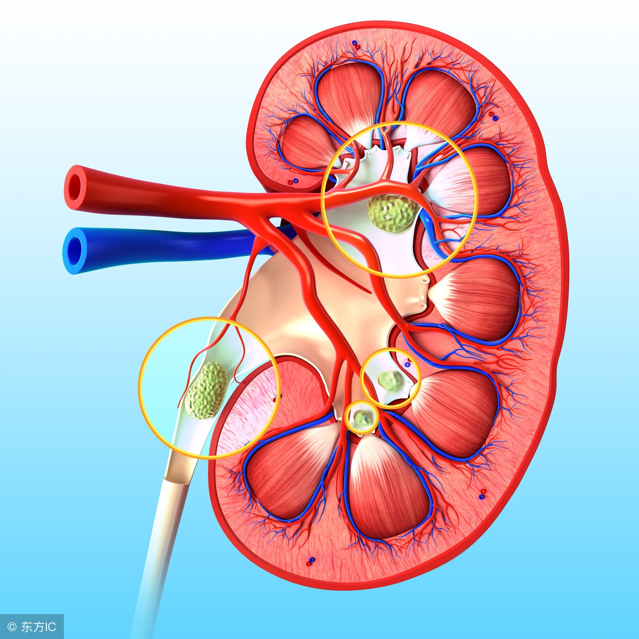 肾结石最佳治疗时间如何治疗