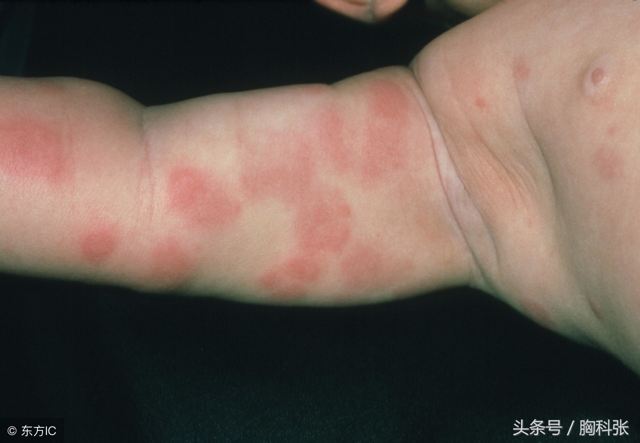 医生胸科张告诉你:遇到药物过敏,我们该怎么办?