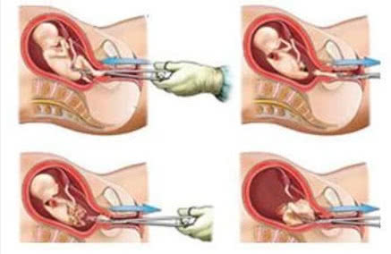 引产过的女人能要吗,引产一年后适合再次引产吗