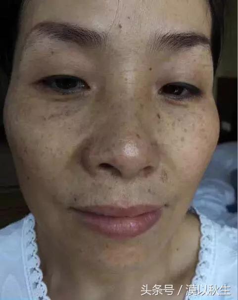 一支牙膏这样抹脸3天斑点消失,用什么牙膏可以去除脸上的斑点