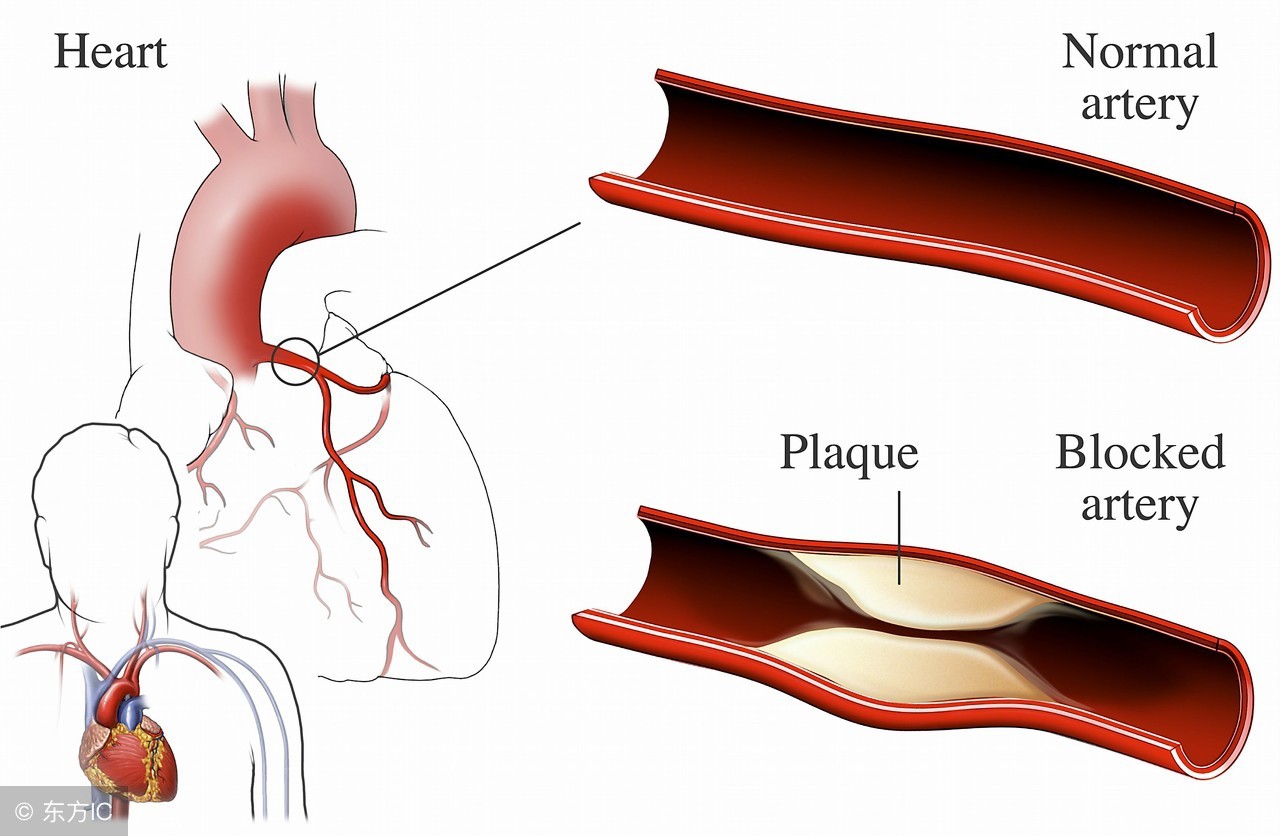 冠状血管阻塞的症状,血管阻塞七大征兆