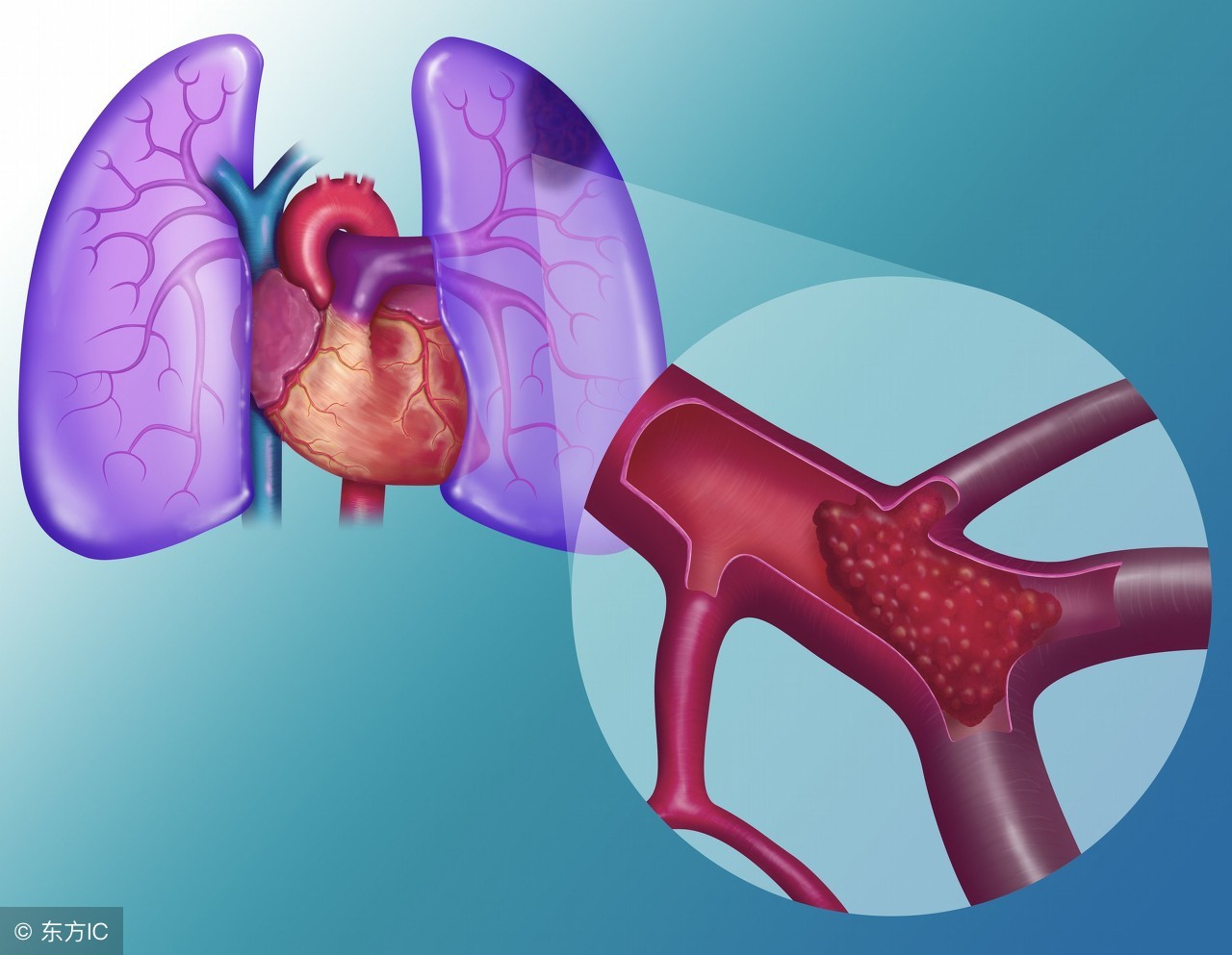 冠状血管阻塞的症状,血管阻塞七大征兆