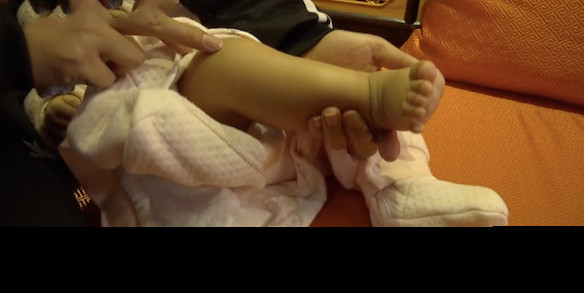 推拿后出现淤青多长时间能消下去,儿童推拿淤青