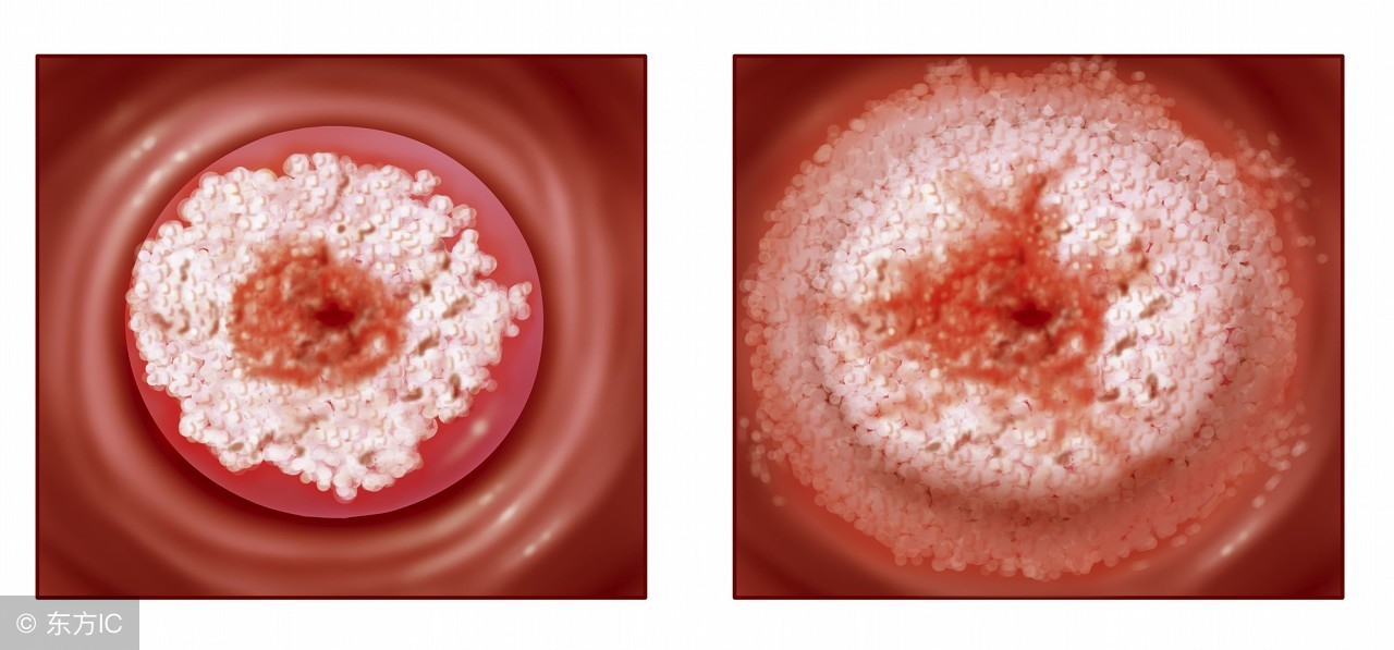 子宫颈肿瘤阴道出血怎么没症状,子宫颈良性肿瘤严重吗