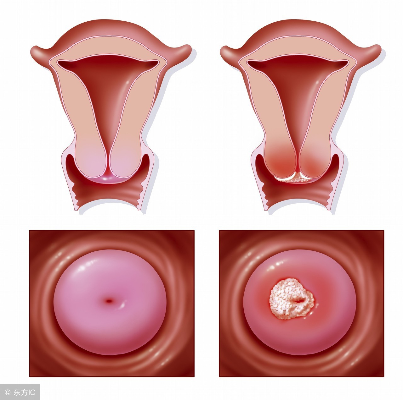 子宫颈肿瘤阴道出血怎么没症状,子宫颈良性肿瘤严重吗