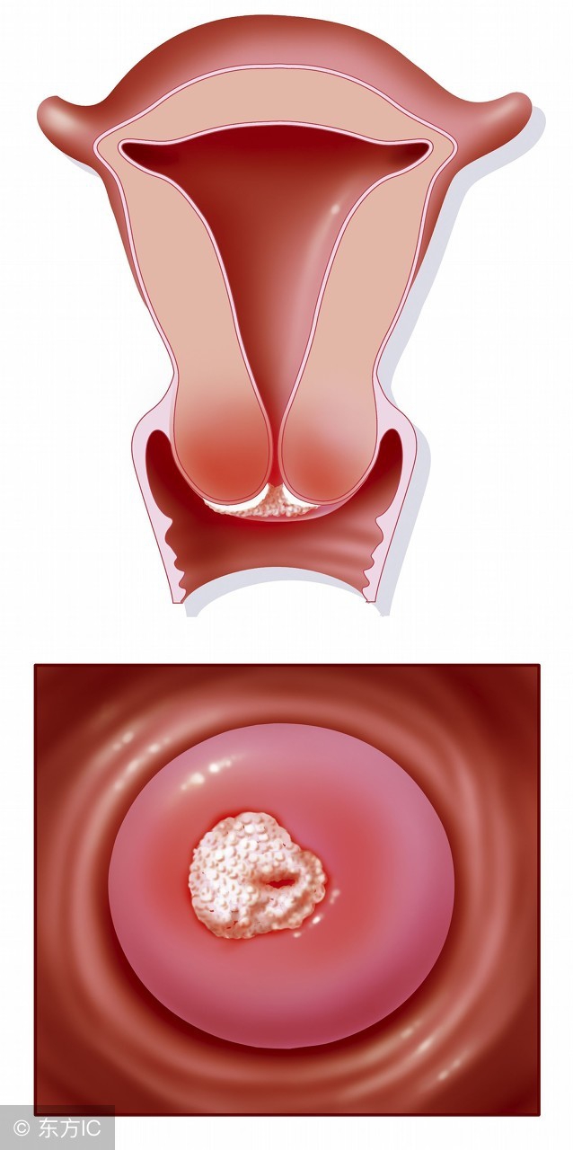 子宫颈低级别鳞状上皮内肿瘤,子宫颈恶性肿瘤有什么症状