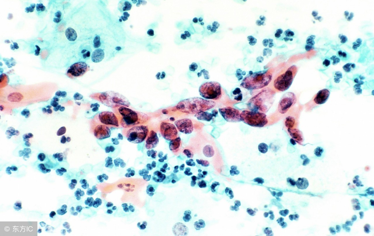 子宫颈低级别鳞状上皮内肿瘤,子宫颈恶性肿瘤有什么症状