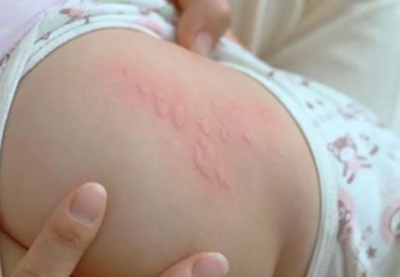 小孩突然全身发痒啥原因,孩子突然全身发痒怎么治病