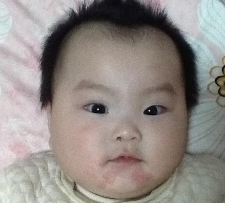 宝宝得了口水疹,口水疹可以抹口水疹膏吗